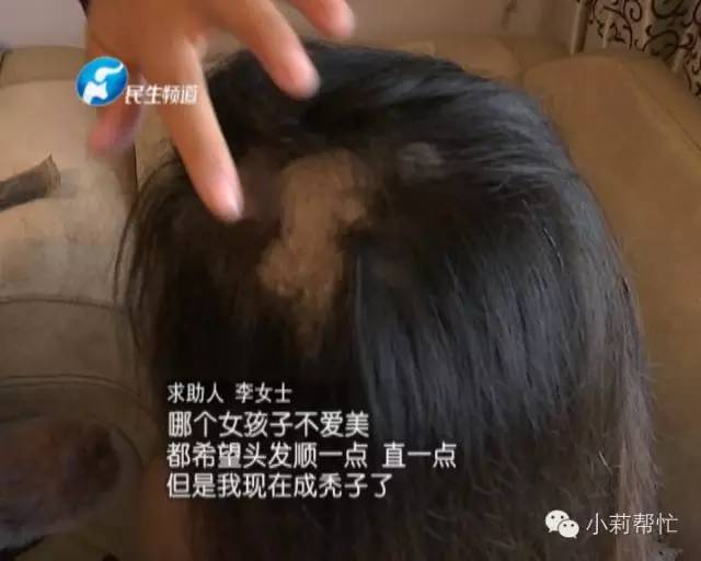 爱美的她竟然成了秃子！这样的事你也做过，看你以后还敢不敢再…