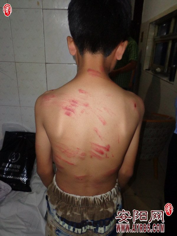滑县百名小学生被“烧饼男”恐吓 被打遍体鳞伤