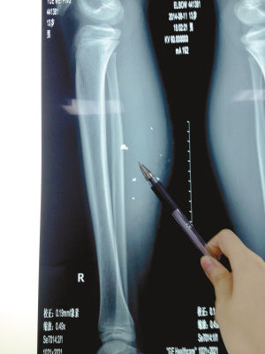 X光片显示：手机电池内的物质被炸进了小平的右小腿里