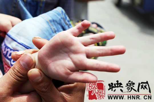 信阳:幼儿园教师关门夹伤三岁男童手指