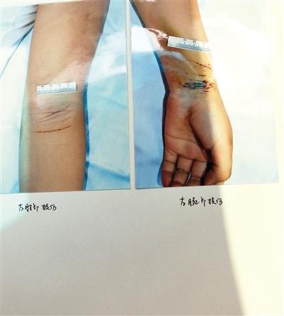 　　6月3日，在学校里，学生新新（化名）划伤自己的手腕。图/CFP