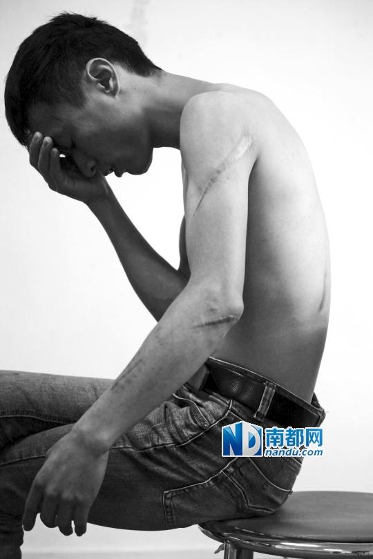 虽然已经过去5个月，但受害人马涛林身上的伤疤依然清晰可见