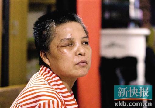 4月初,赵女士遭人抢劫并被打伤,现今右眼失明,头部被缝100多针。记者 毕志毅/摄