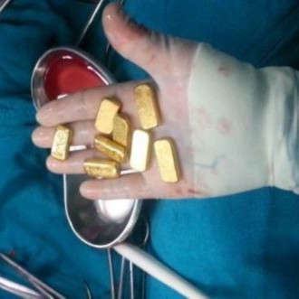 富商12根金条藏腹部
