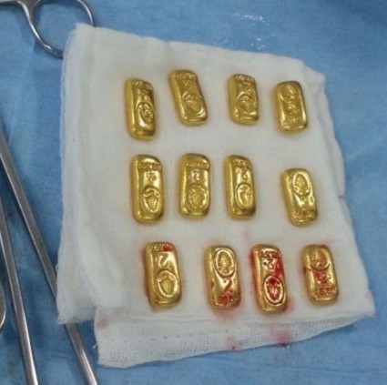 富商12根金条藏腹部