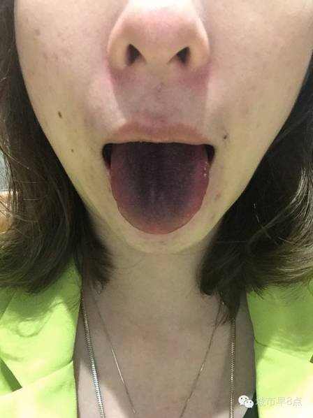 女子吃火锅舌头变黑 商家：没及时加汤