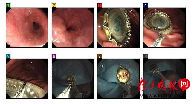 男子喝酒太猛吞下瓶盖 医生用避孕套取出