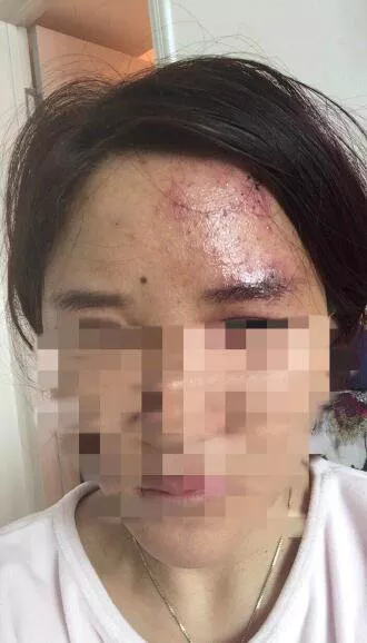 两女子网购玻尿酸互相注射 一针下去差点失明