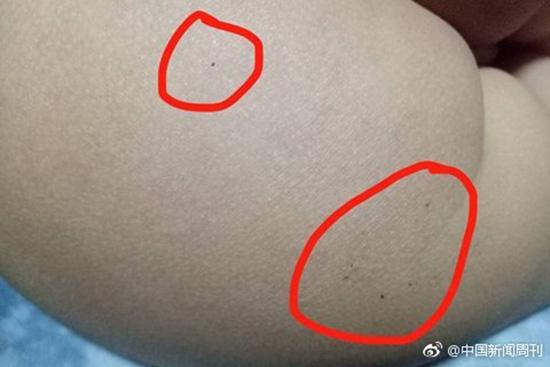 据多名红黄蓝(新天地分园)家长反映，孩子腿部、屁股、腋下出现针眼。