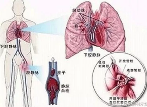 熊孩子往输液瓶里注脏水 致使奶奶生命垂危