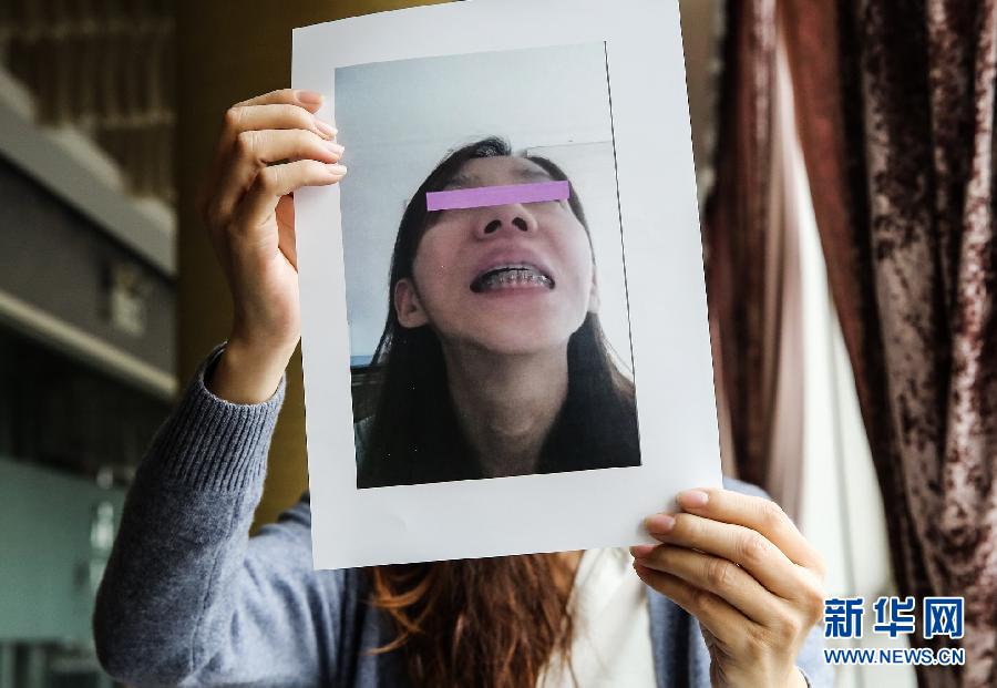 赴韩整形失败者周君（化名）向记者展示她的术后照片（4月1日摄）。