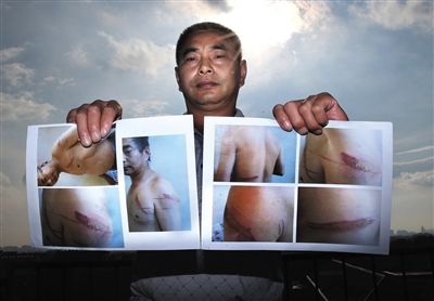 王维龙出示在张家口被关时被虐受伤的照片。