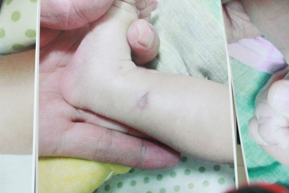 孩子腿部的伤口照片 （患儿家长提供）