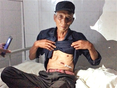 缅甸难民杨开顺撩起上衣展示在炸弹袭击中留下的伤疤。
