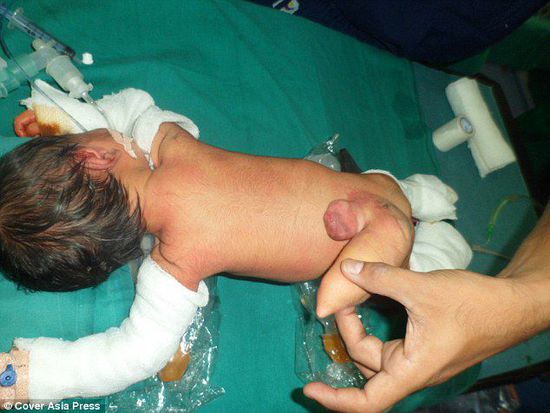 印度新生男婴背部长12厘米尾巴被切除