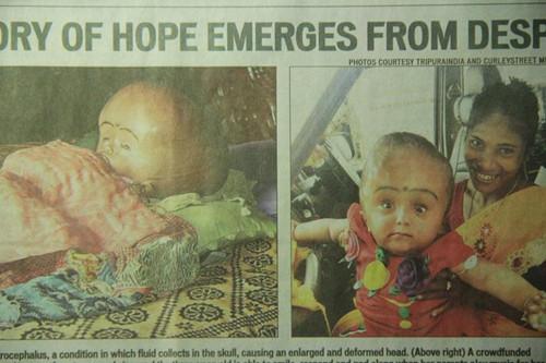 患有先天水脑症的印度女童贝冈。