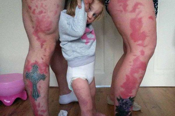 一对英国夫妇为了不让女儿的胎记显得与众不同，在自己的身上纹了与其胎记一模一样的纹身。（图片来源：《镜报》）