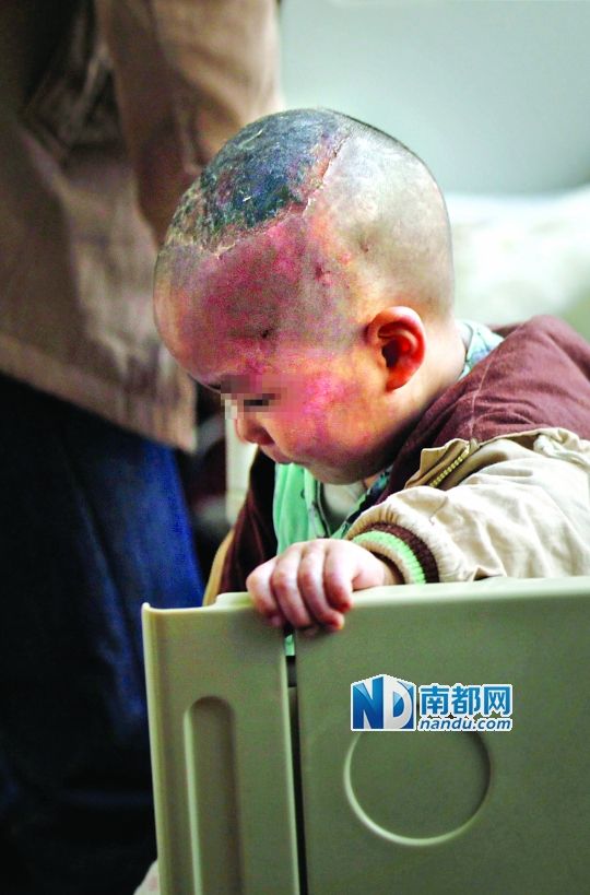1月8日下午，小宝头上和脸上都是伤痕。