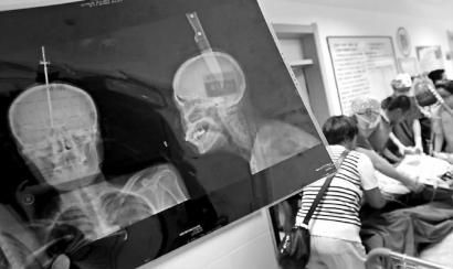 水果刀插在头部的X光片 记者 李洪亮 摄