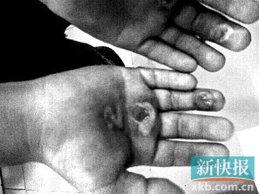 广州一男孩被学长用烟头烫烂手掌 踢伤下体(图)