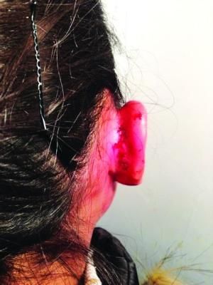 贵州小学生遭体罚耳朵缝7针 涉事教师正被调查