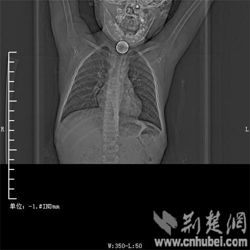 6岁男童玩耍被1元硬币卡住喉 窒息险丧命(图)