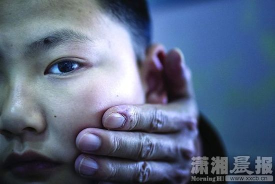 1月13日，小珏的父亲心疼地摸着儿子的脸。