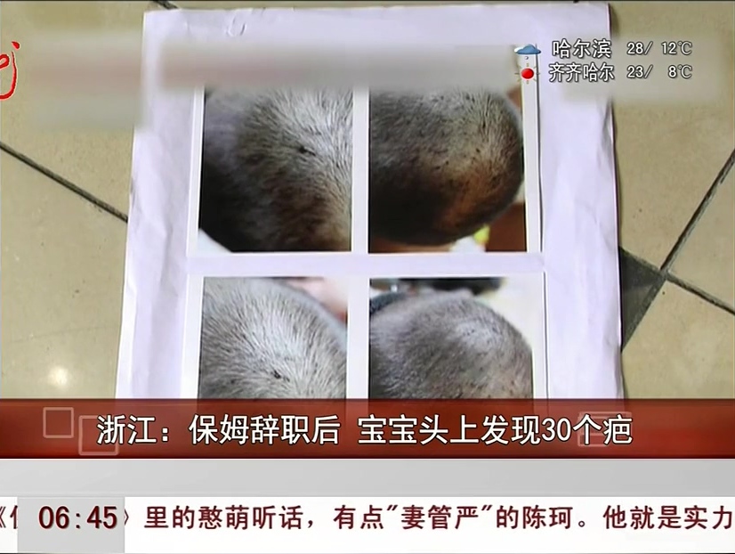 浙江：保姆辞职后 宝宝头上发现30个疤