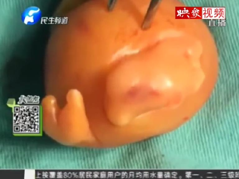 男婴出生15天 腹中竟取出胎儿