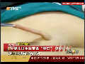 广州初生女婴长出6厘米柔软尾巴